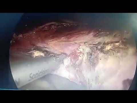 Laparoscopic Uterus Removal