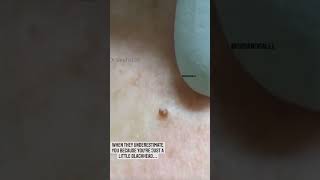 Download lagu Small BUT Mighty Blackhead | Dr. Pimple Popper #shorts #youtubeshorts #pimple #blackhead #popping mp3 Download lagu Small BUT Mighty Blackhead | Dr. Pimple Popper #shorts #youtubeshorts #pimple #blackhead #popping mp3