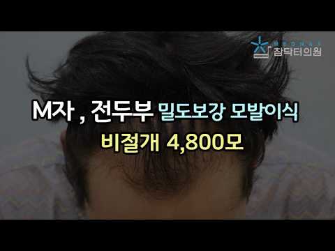 M자, 전두부 밀도보강 모발이식 4,800모 [수술 후 2년 후~3년 후]