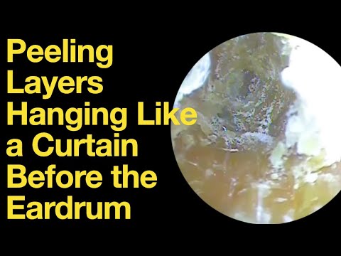 Peeling Layers Hanging Like a Curtain Before the Eardrum|ear wax removal | ear cleaning | ASMR