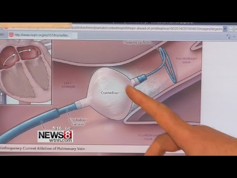 Latest approach for A-fib - a major cause of stroke