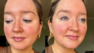 Beginner skincare routine to reduce redness or rosacea