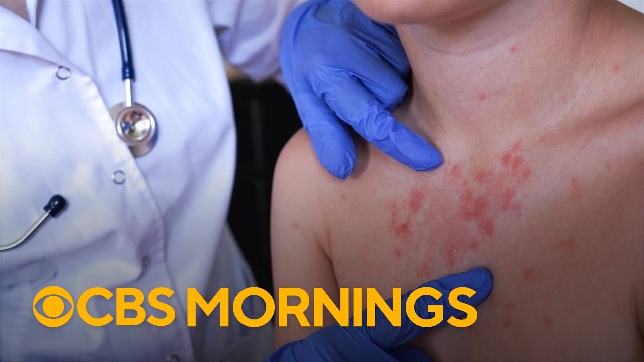 Pennsylvania's 4th measles-related death sparks vaccination concerns
