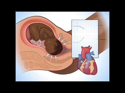 Early Decelerations - Fundamentals of Fetal Health Surveillance