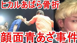 【骨折】ビンタされたら病院送りになった件