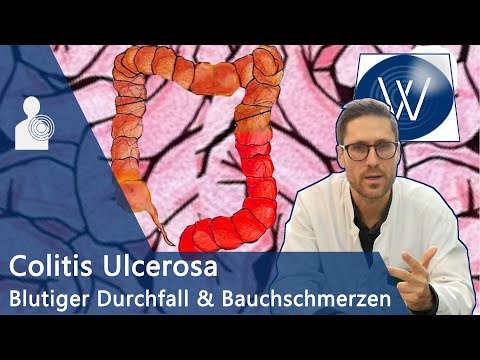 Colitis Ulcerosa: Bauchschmerz & schleimig blutiger Durchfall? Hilfe bei Chronischer Darmerkrankung