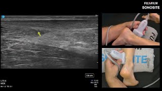 Using Ultrasound to Evaluate the Posterior Ankle