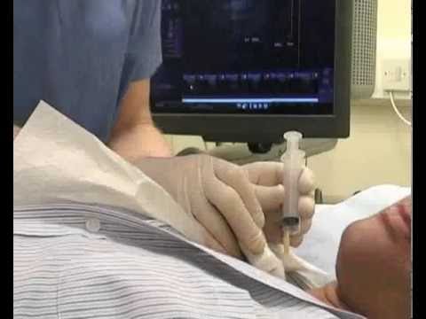 Performing an FNA under ultrasound guidance