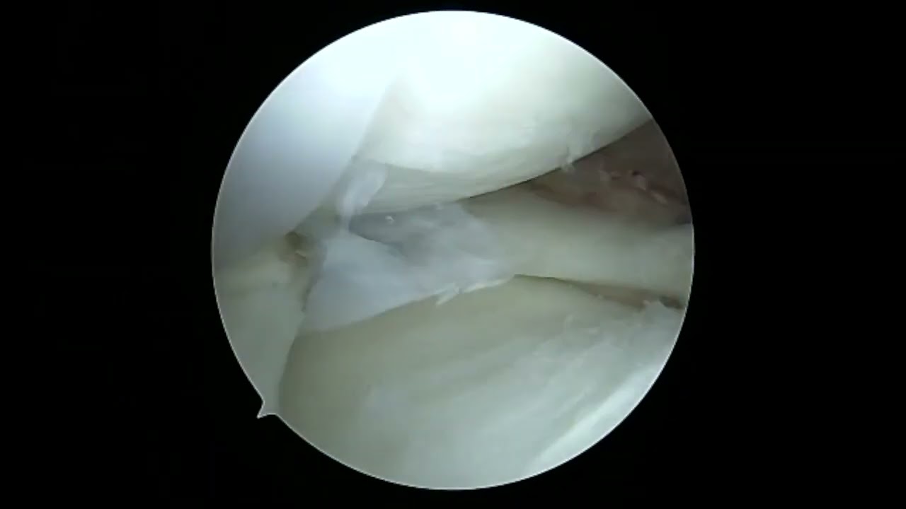 ACL Recon with Lateral Root Repair with Sutureloc