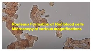 Rouleaux Formation of Red blood cells Microscopy at various magnifications