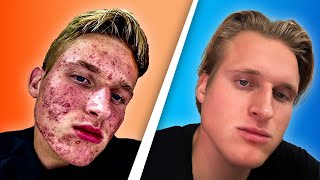 How I Cured My Acne Naturally (Only THIS worked!)