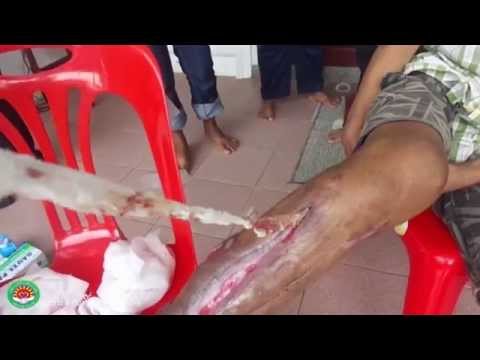 เป็นยาในการรักษาโรคสะเก็ดเงิน วิธีการป้องกันโรคสะเก็ดเงิน