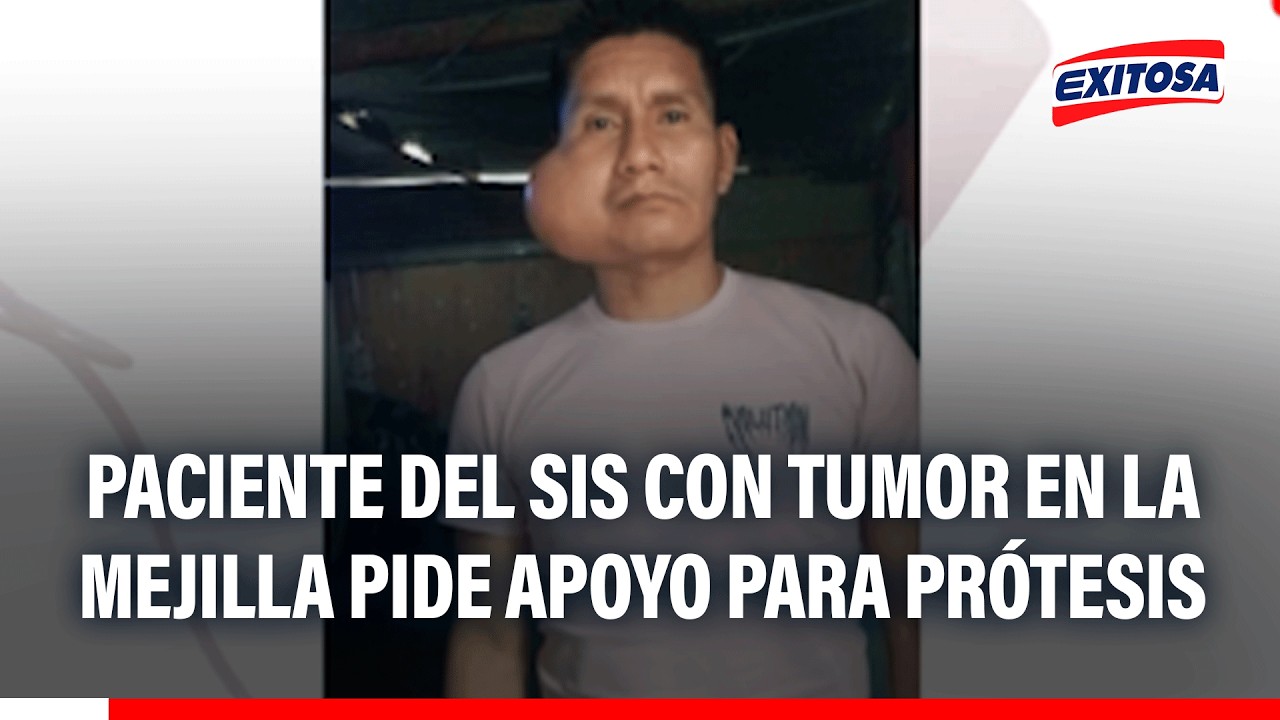 🔴🔵 Paciente del SIS con tumor en la mejilla pide apoyo para prótesis de S/ 42 mil tras operación