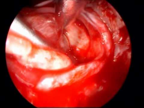 Technique Of Pseudocapsule And Easy Slip-Knot 