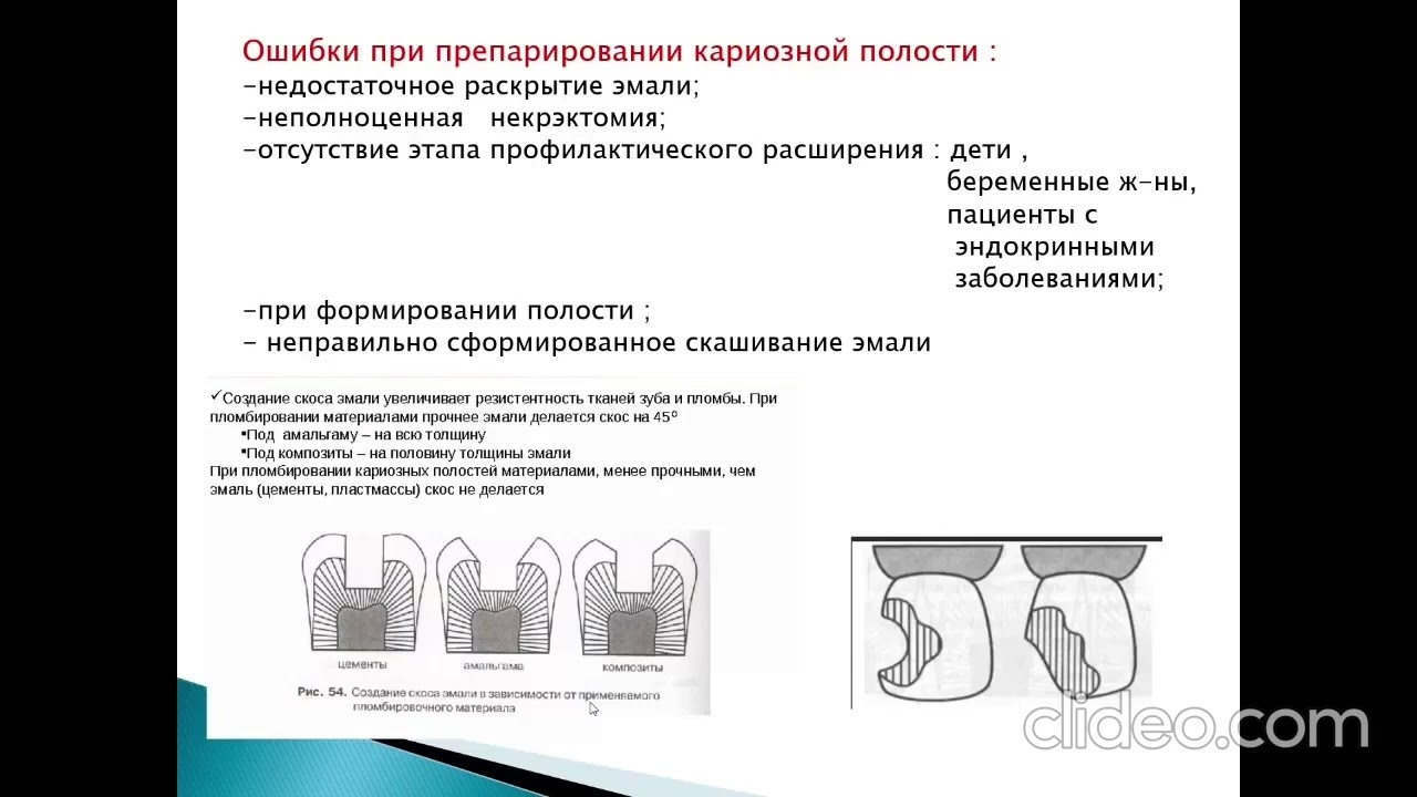 Распространенные ошибки и осложнения при диагностике и лечении кариеса