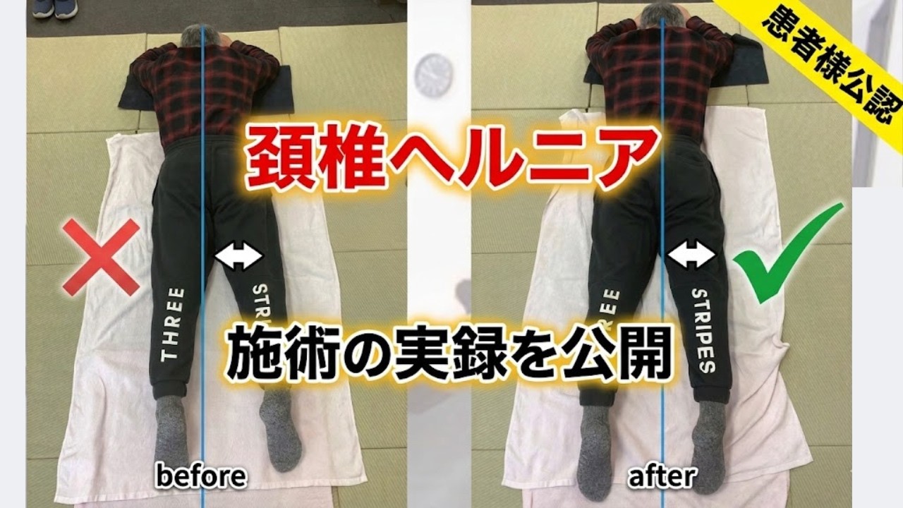 【西宮　頚椎ヘルニア治療】実際の治療風景。頚椎ヘルニアで悩んでいる方への全身整体｜兵庫県西宮市ひこばえ整骨院