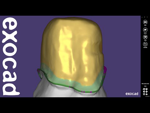 exocad Quick Guide: Crown Bottoms