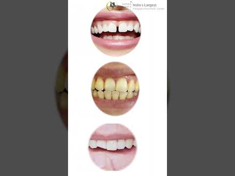 Get Your Dream Smile with Porcelain Veneers in Hyderabad | Cosmo Radiance