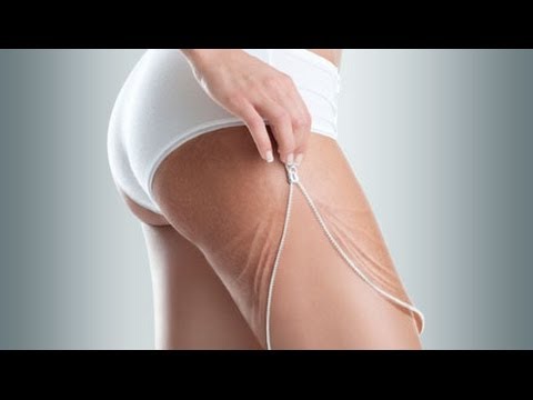 comment traiter efficacement la cellulite