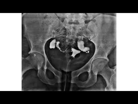Diagnóstico de obstrução tubárea bilateral pela histerossalpingografia