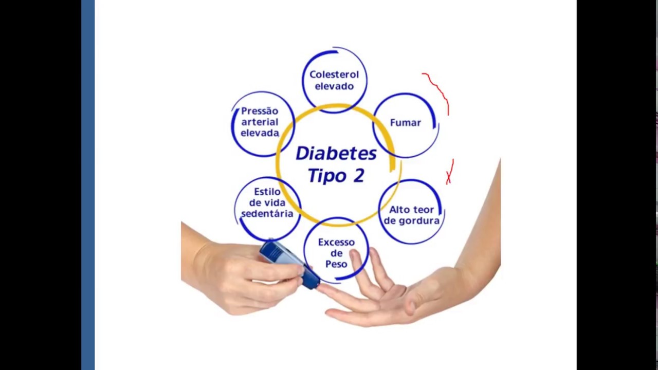 Diabetes : fisiopatologia e suas complicações : PARTE 3 ( DM TIPO II)