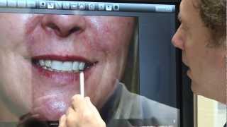 preview picture of video 'Lip Augmentation by Dr. Martin Luftman in Lexington, KY'