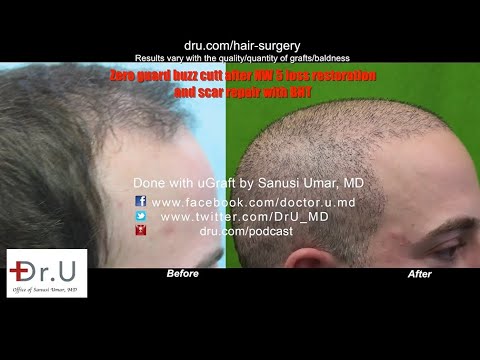 NW 5 Hair Restoration with BHT Body Hair Transplant -...