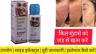 Acnesol 1% Solution is an effective medicine for treating pimples and acne. Uses, Benefits, Side ...