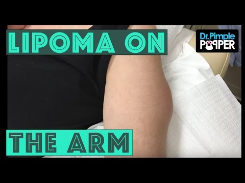 lipoma férgek