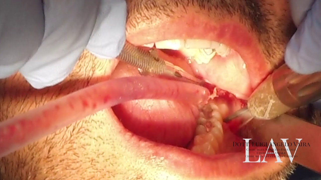 Watch Now Estrazione chirurgica di dente del giudizio - Dott. Vaira Chirurgo Maxillo-Facciale Sassari Estrazione chirurgica di dente del giudizio - Dott. Vaira Chirurgo Maxillo-Facciale Sassari