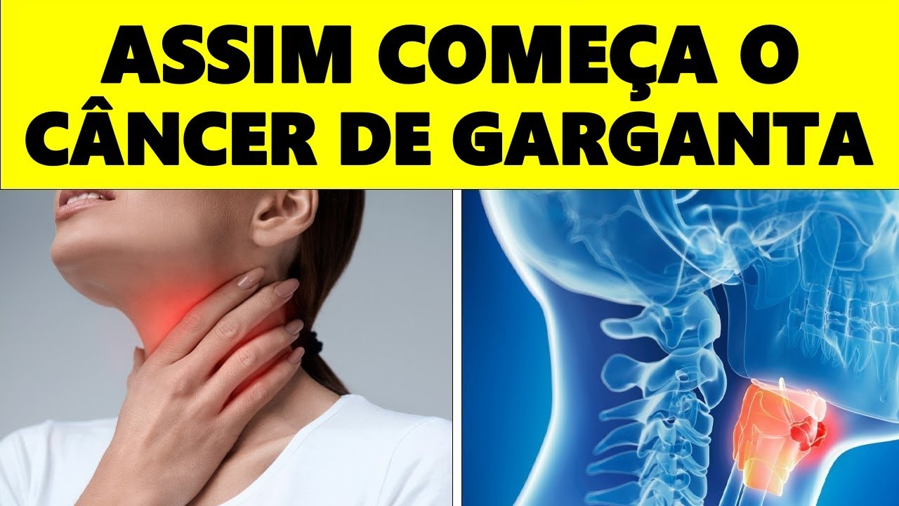 É assim que o Câncer de Garganta começa e ninguém lhe conta – Sinais e Sintomas que você DEVE Saber