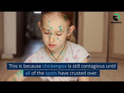 When Can My Child Go Back To School After Chickenpox