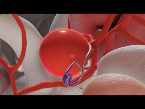 Aneurysm Clipping (3D Animation)