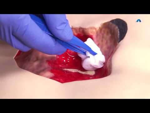 How to Effectively Cleanse and Debride a Wound | Wound Cleansing and Debridement | Ausmed Education