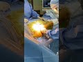 Femur Head REmoval in Hip Replacement Surgery #shorts