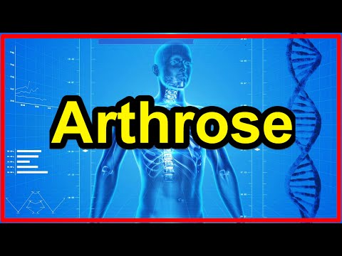 Traktion mit Osteochondrose ICD-10 Code Schultergelenkarthrose