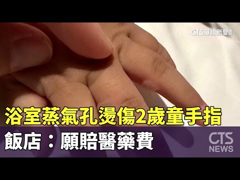 浴室蒸氣孔燙傷2歲童手指　飯店：願賠醫藥費