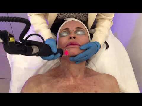 Cool Laser in Action | Lisa Harris Skin Science