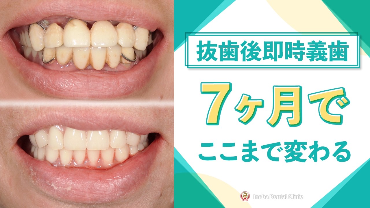 抜歯後即時義歯、7ヶ月でここまで変わる