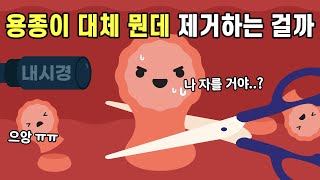 내시경을 할 때 제거하는 용종이란 대체 뭘까