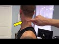Massive Neck KNOT Sends Pain Down His Arm Thoracic Outlet Syndrome Cracks Deep Massage
