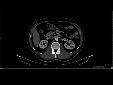 Neuroendocrine pancreas tumor in uncinate process