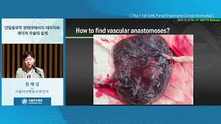 The 11th AMC Fetal Treatment Center Workshop : 단일융모막 쌍태아에서의 태아치료: 레이저 수술의 실제 미리보기