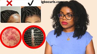 Braid Bumps - (HOW-TO) Tips To PREVENT & HEAL Bumps from (TIGHT) Braided Hair