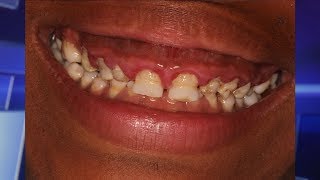 Ovarian Cancer Risk Passed on from Father?; Myth or Reality; A Complete Mouth Makeover