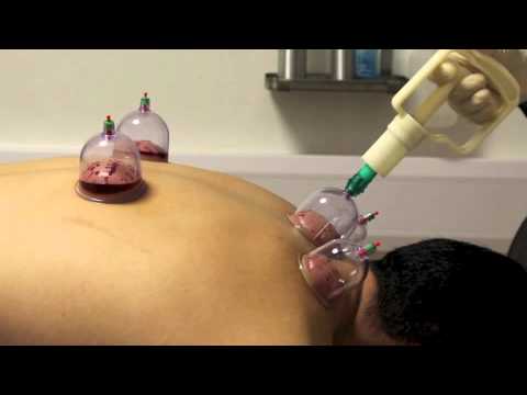 download lagu mp3 mp4 Hijama Center, download lagu Hijama Center gratis, unduh video klip Hijama Center