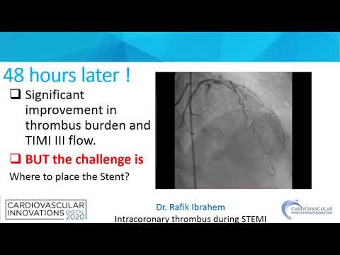Ibrahem_Intracoronary thrombus during STEMI_Coronary Case