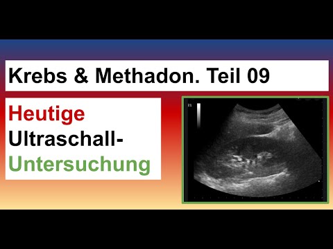 Meine Methadon Krebstherapie, Teil 09. Heutige Ultraschall-Untersuchung beim Onkologen