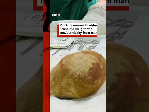 Doctors remove bladder stone the weight of a newborn baby from man. #SriLanka #BBCNews