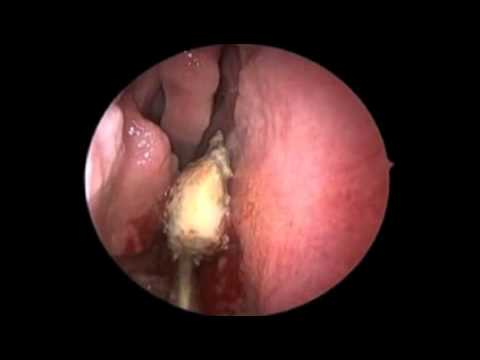 Foreign Body Nose Removal